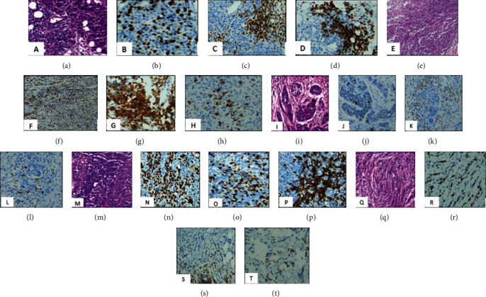 The Impact of Tumor Infiltrating Lymphocytes Densities and Ki67 Index on Residual Breast Cancer Burden following Neoadjuvant Chemotherapy.