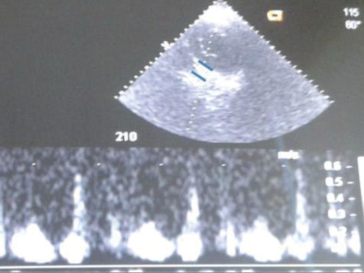 Non Invasive Detection of Coronary Sinus Flow Changes Over Time After CABG.