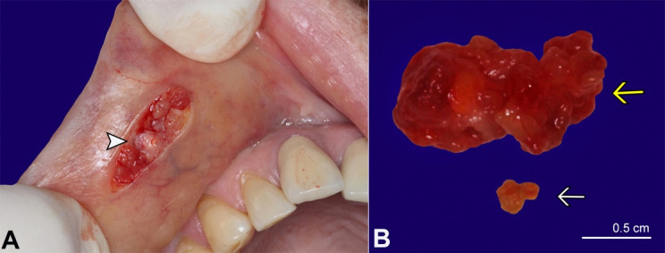 Suppurative minor salivary gland sialolithiasis.