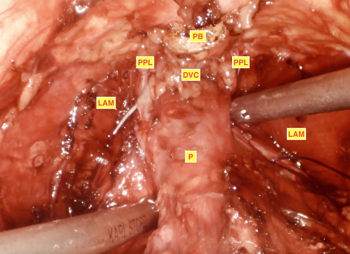 Dorsal Vascular Complex Nonligation Method and Preservation of Puboprostatic Ligaments and Endopelvic Fascia During Laparoscopic Radical Prostatectomy: Effect on Continence.