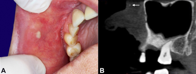 Suppurative minor salivary gland sialolithiasis.