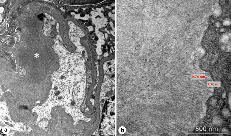 Primary Sclerosing Cholangitis and Amyloid A Amyloidosis: Association or Coincidence?