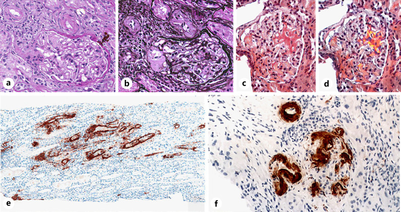 Primary Sclerosing Cholangitis and Amyloid A Amyloidosis: Association or Coincidence?