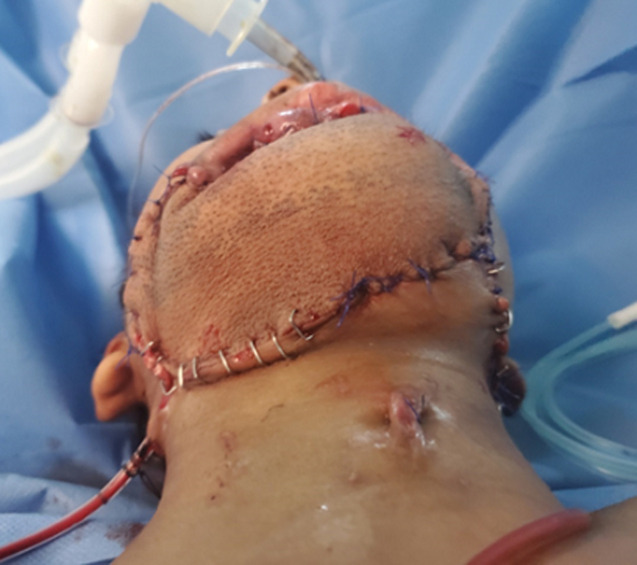 Microsurgical reconstruction of the enormous traumatic oromandibular defect by osteocutaneous fibula-free flap in a 9-year-old child: a case report.