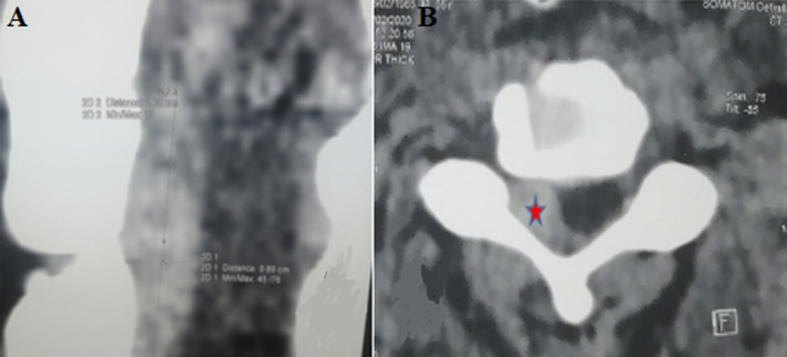 Cervical epidural hematoma post-trauma: a case report.