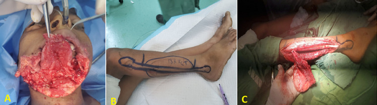 Microsurgical reconstruction of the enormous traumatic oromandibular defect by osteocutaneous fibula-free flap in a 9-year-old child: a case report.