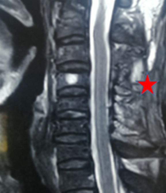 Cervical epidural hematoma post-trauma: a case report.