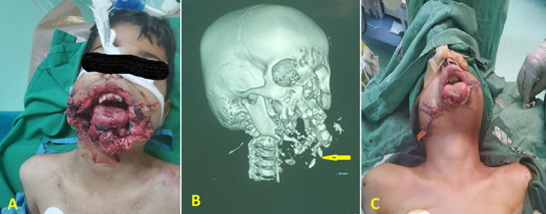 Microsurgical reconstruction of the enormous traumatic oromandibular defect by osteocutaneous fibula-free flap in a 9-year-old child: a case report.