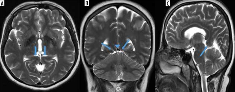 The prevalence of isolated tentorial hypoplasia on magnetic resonance imaging.