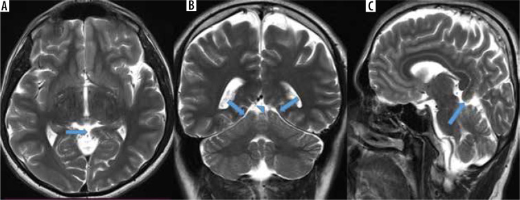 The prevalence of isolated tentorial hypoplasia on magnetic resonance imaging.
