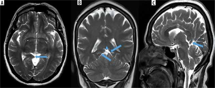 The prevalence of isolated tentorial hypoplasia on magnetic resonance imaging.