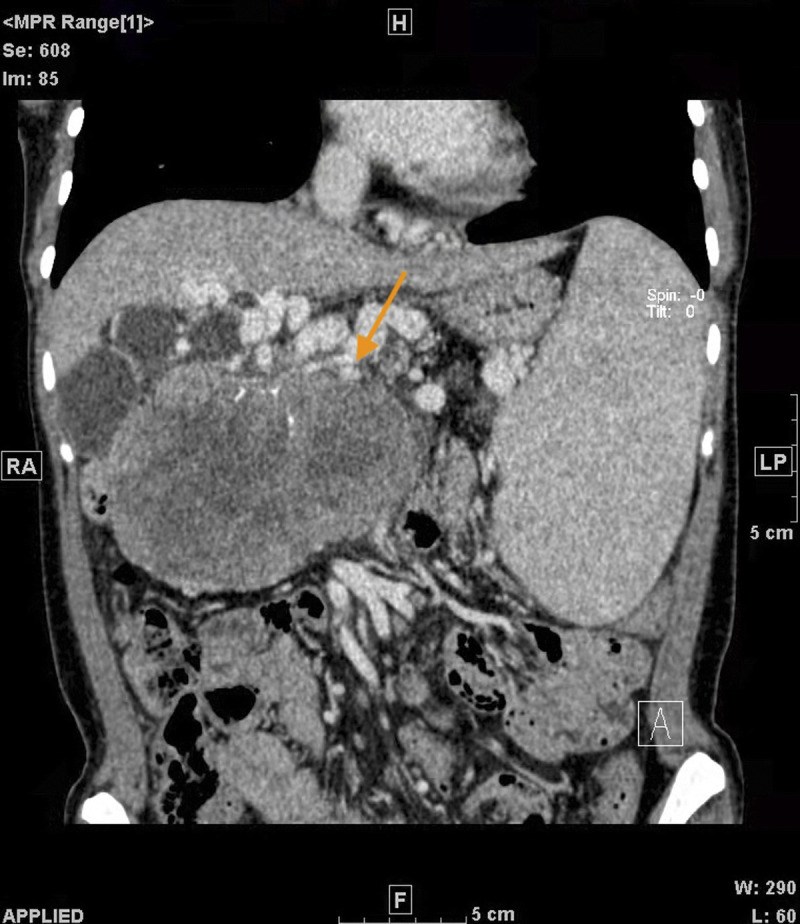 Pregnancy Complicated With a Giant Pancreatic Tumor and Decompensation of Liver Cirrhosis: A Case Report and Literature Review.