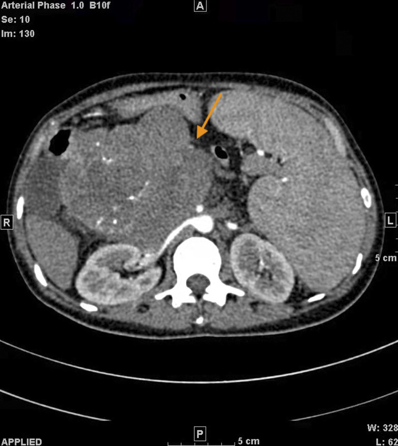 Pregnancy Complicated With a Giant Pancreatic Tumor and Decompensation of Liver Cirrhosis: A Case Report and Literature Review.