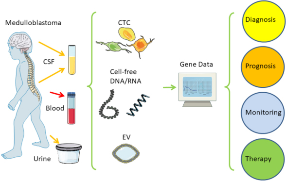 Liquid biopsy for monitoring medulloblastoma.