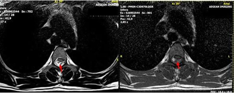 Spontaneous Thoracic Spinal Epidural Hematoma During Pregnancy.