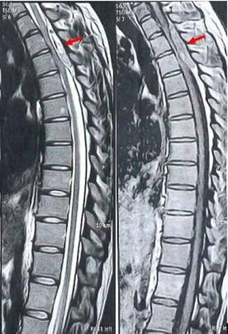 Spontaneous Thoracic Spinal Epidural Hematoma During Pregnancy.