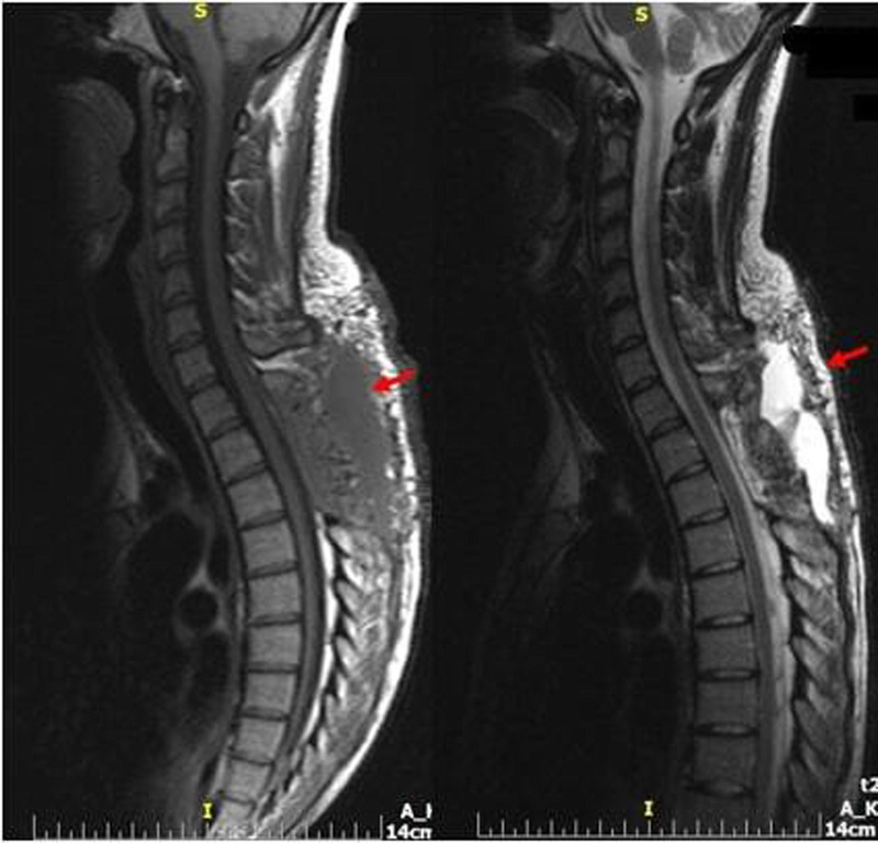 Spontaneous Thoracic Spinal Epidural Hematoma During Pregnancy.