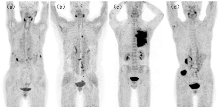 Comparison of physiological uptake of normal tissues in patients with cancer using <sup>18</sup>F-FAPI-04 and <sup>18</sup>F-FAPI-42 PET/CT.