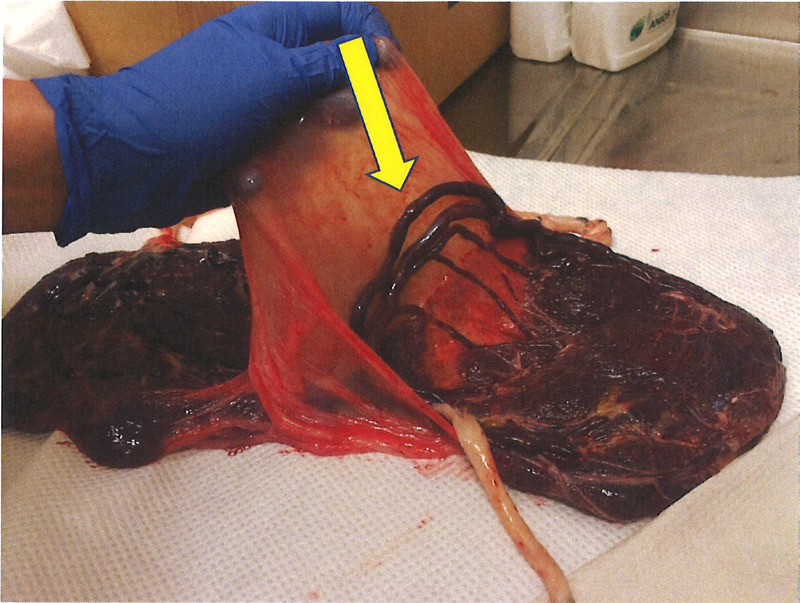 The Umbilical Cord and Complications of Twin Gestations.
