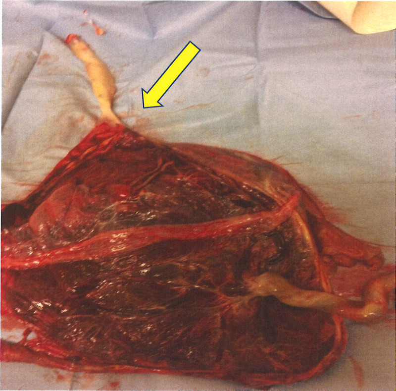 The Umbilical Cord and Complications of Twin Gestations.