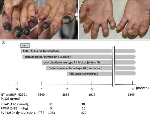 Development of severe fingertip ulcers, pulmonary hypertension, and scleroderma renal crisis in a patient with systemic sclerosis and anti-PL12 antibodies