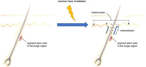 Role of pigment stem cells in hair follicles in the treatment of vitiligo with a 308-nm excimer laser: An immunohistochemical study of human cases