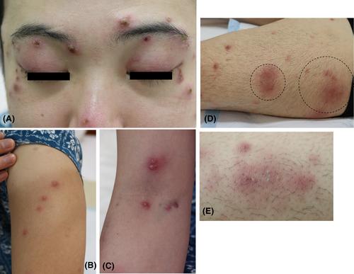 Neutrophilic dermatosis with necrobiotic changes as an unusual manifestation after the first shot of a COVID-19 mRNA vaccine together with a high fever and liver injury