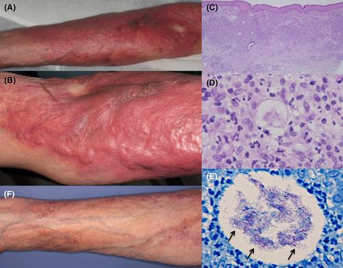 A case of cutaneous Mycobacterium chelonae infection requiring a differential diagnosis of Mycobacterium stephanolepidis infection