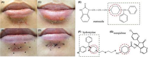 Hydroxyzine-induced fixed drug eruption and cross-reaction with oxatomide