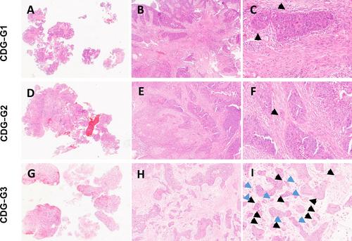 Cellular dissociation grading on biopsies of pulmonary squamous cell carcinoma provides prognostic information across all stages and is congruent with resection specimen grading