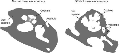 Considering gene therapy to protect from X-linked deafness DFNX2 and associated neurodevelopmental disorders