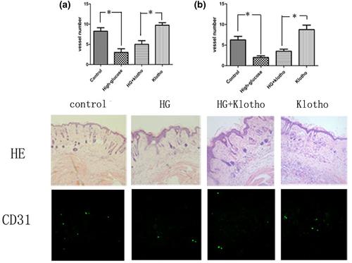 The effect of Klotho protein complexed with nanomaterials on bone mesenchymal stem cell performance in the treatment of diabetic ischaemic ulcer