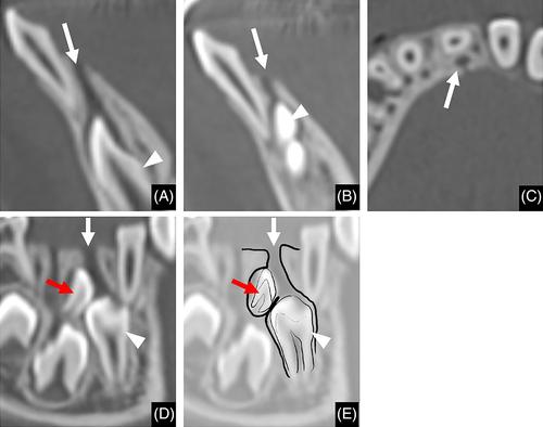 Imaging characteristics of the gubernaculum tracts in successional teeth related to deciduous fused teeth on computed tomography