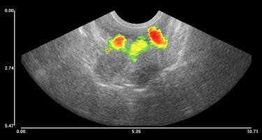 Detection of magnetomotive ultrasound signals from human tissue