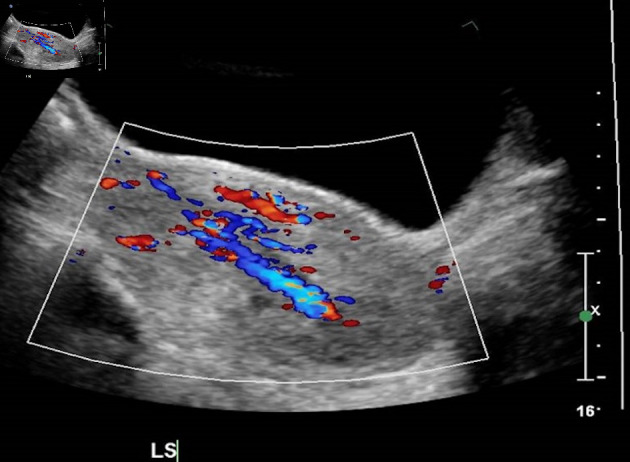 Uterine Inversion Secondary to Endometrial Carcinoma.