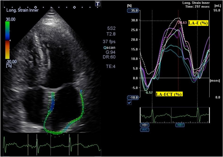 Left atrial strain is associated with distinct inflammatory and immune profile in patients with COVID-19 pneumonia.