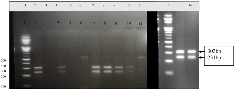 Detecting the Frequency of c.5946delT Pathogenic Variant in the <i>BRCA2</i> Gene and Associated Risk Factors Among Breast Cancer Patients Visiting Felege Hiwot Referral Hospital and University of Gondar Comprehensive Specialized Hospital.