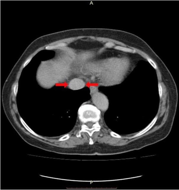 The Role of Intraoperative Transesophageal Echocardiography in the Management of Renal Cell Carcinoma with Atrial Thrombus - Case Report.