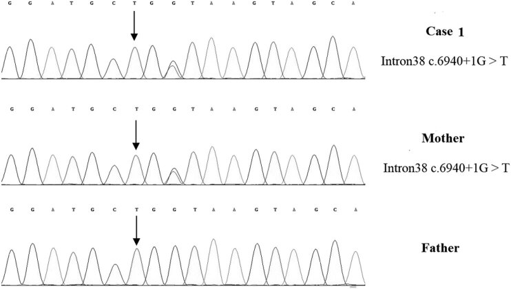 Deletion as novel variants in VPS13B gene in Cohen syndrome: Case series.