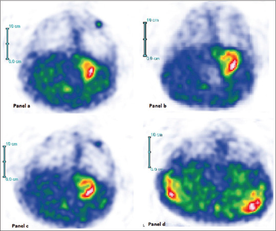 Application of Breast Scintigraphy for Patients with Suspicious (Breast Imaging-Reporting and Data System IV) Breast Lesions.