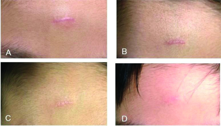 Real-world management of abnormal scarring using topical silicone gel: expert consensus and case series from the Asian SCARS Expert Group.