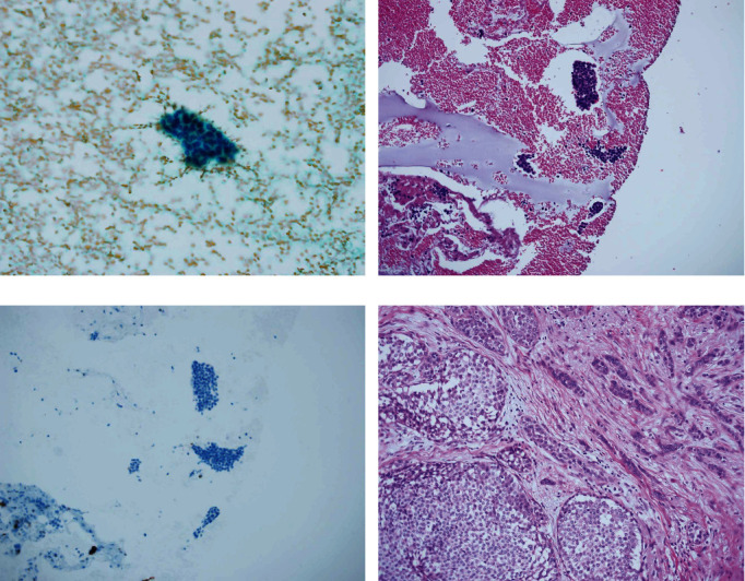 Combined Use of Cell Block and Smear Improves the Cytological Diagnosis of Malignancy in Non-Palpable Breast Lesions Screened by Imaging.