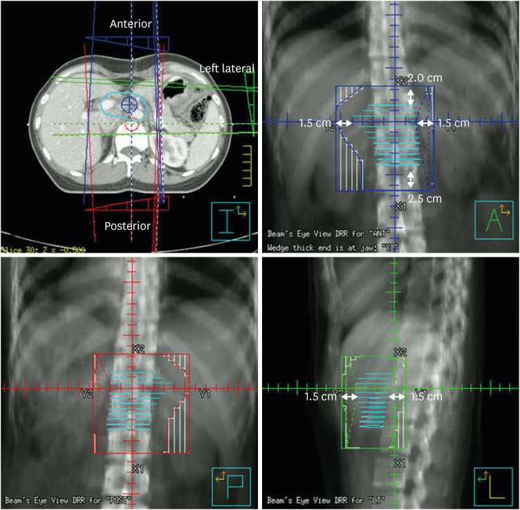 Role of Adjuvant Radiotherapy in Gastric Cancer.