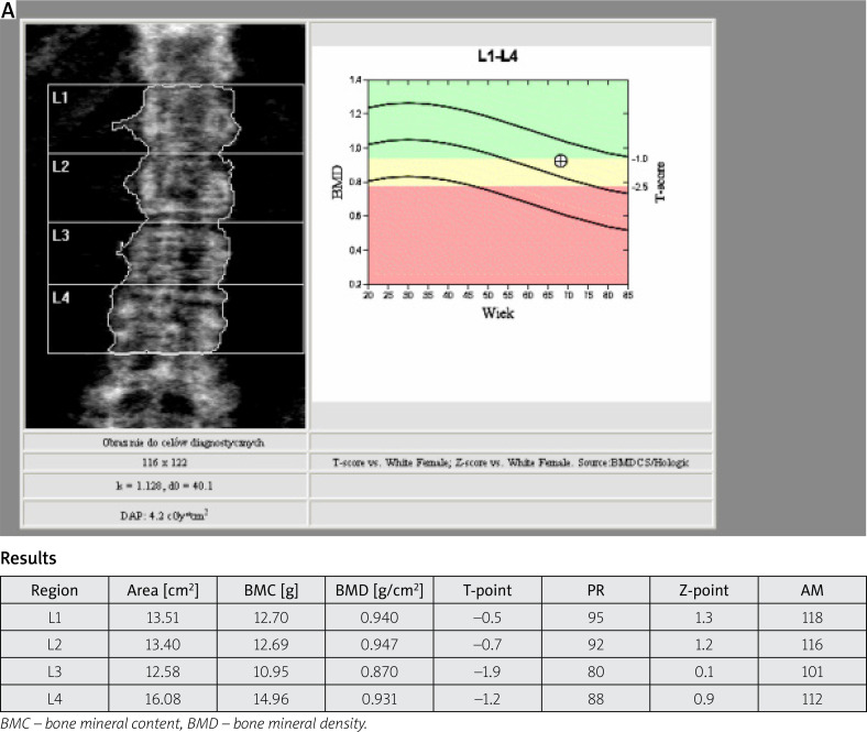 Osteoporosis and diabetes - possible links and diagnostic difficulties.