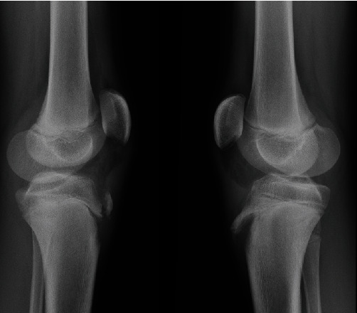 Simultaneous Bilateral Avulsion of Tibial Anterior Tubercle in Adolescent: Two Case Reports and Narrative Review of the Literature.