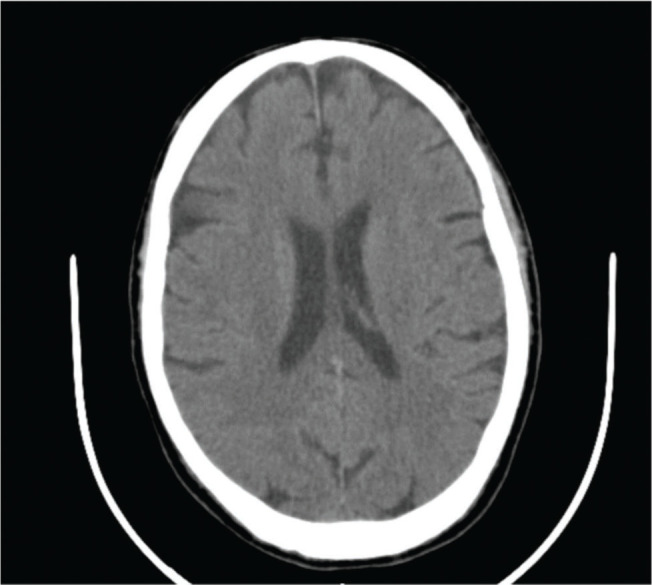 Acute meningitis complicated with ventriculitis caused by <i>Streptococcus dysgalactiae subsp. dysgalactiae</i>.