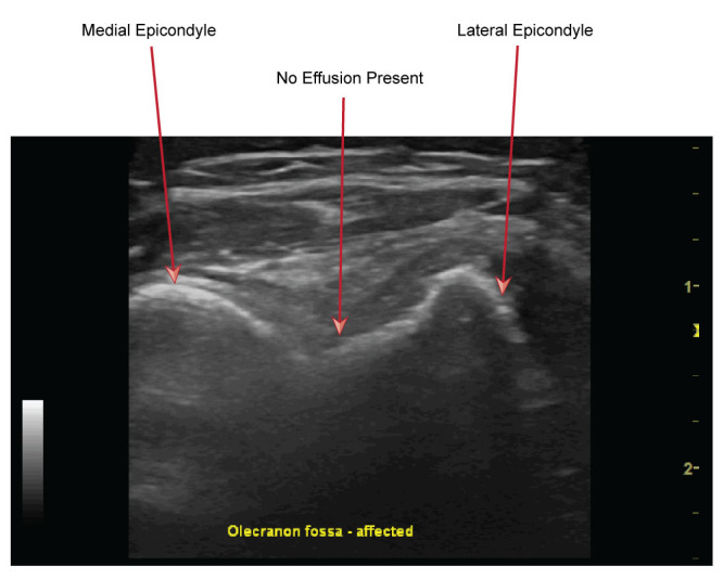 Use Of POCUS for the Paediatric Patient with an Undifferentiated Upper Limb Injury.