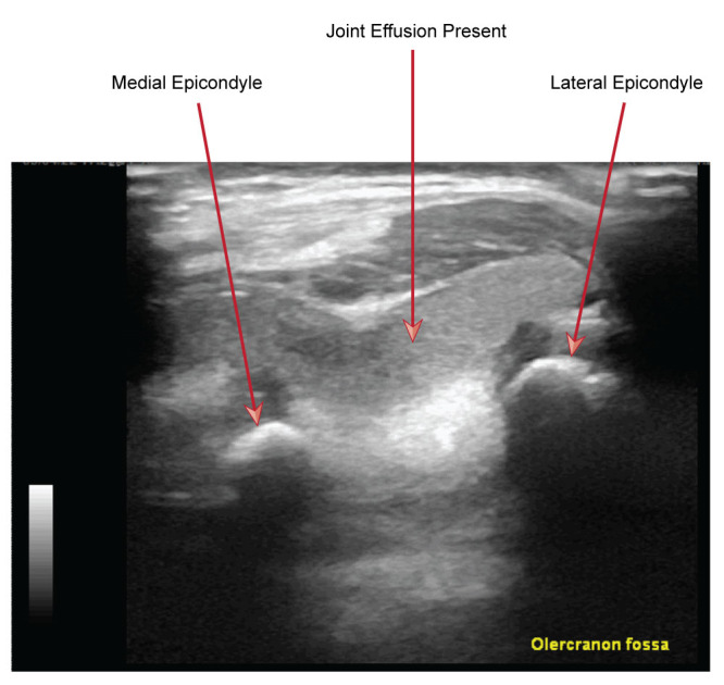 Use Of POCUS for the Paediatric Patient with an Undifferentiated Upper Limb Injury.