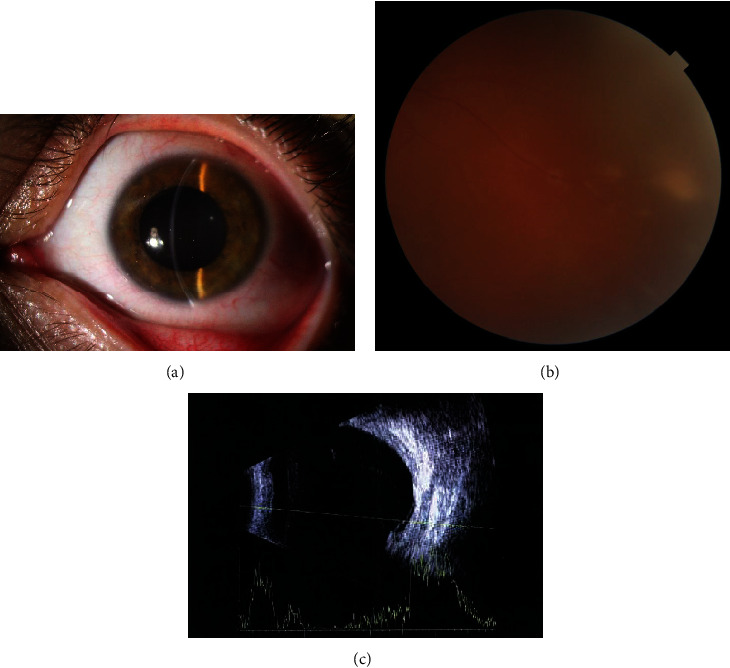 Langerhans Cell Histiocytosis of the Uvea with a Ciliochoroidal Mass: A Case Report of Management with Systemic Therapy.