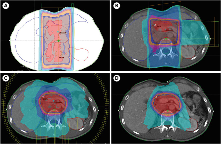 Role of Adjuvant Radiotherapy in Gastric Cancer.